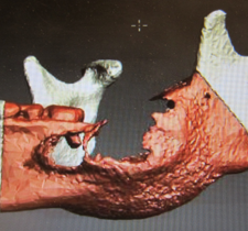 Bone Defects